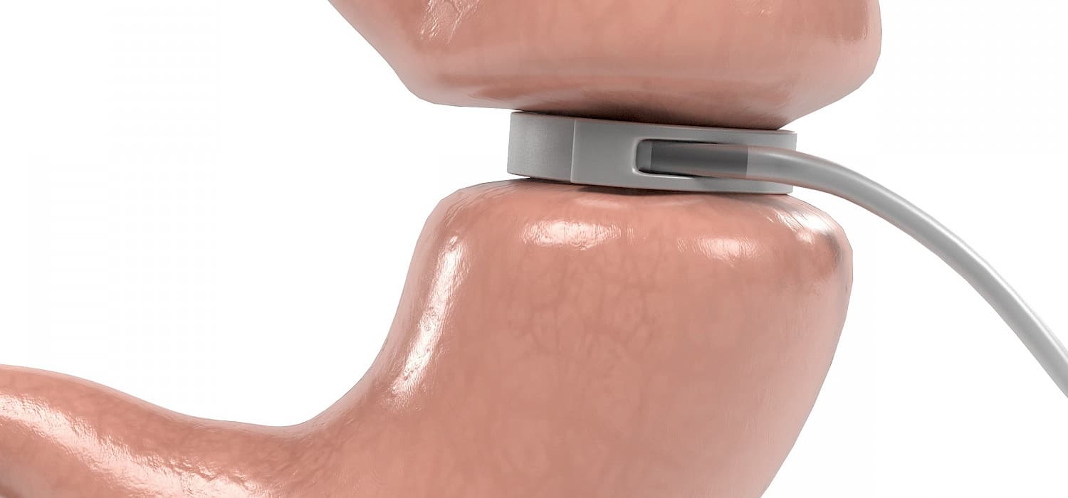 5 things you didn’t know about gastric band hypnotherapy